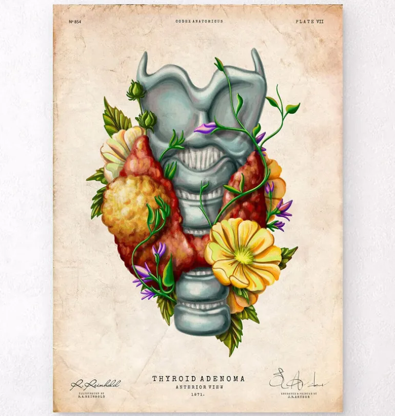 Adénome thyroïdien - Floral - Vintage