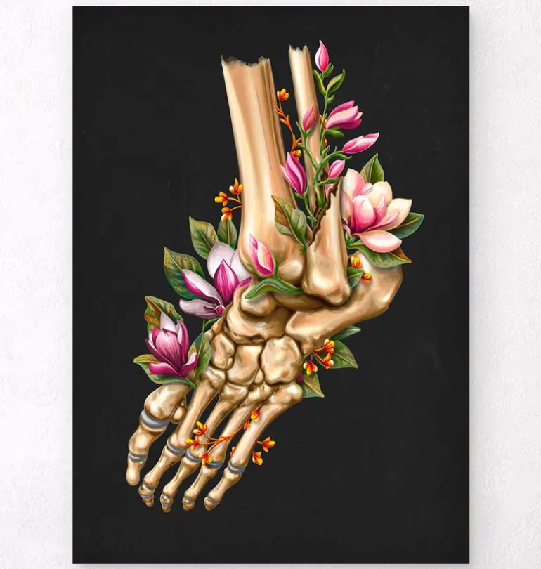 Fracture de la cheville - Floral - Noir