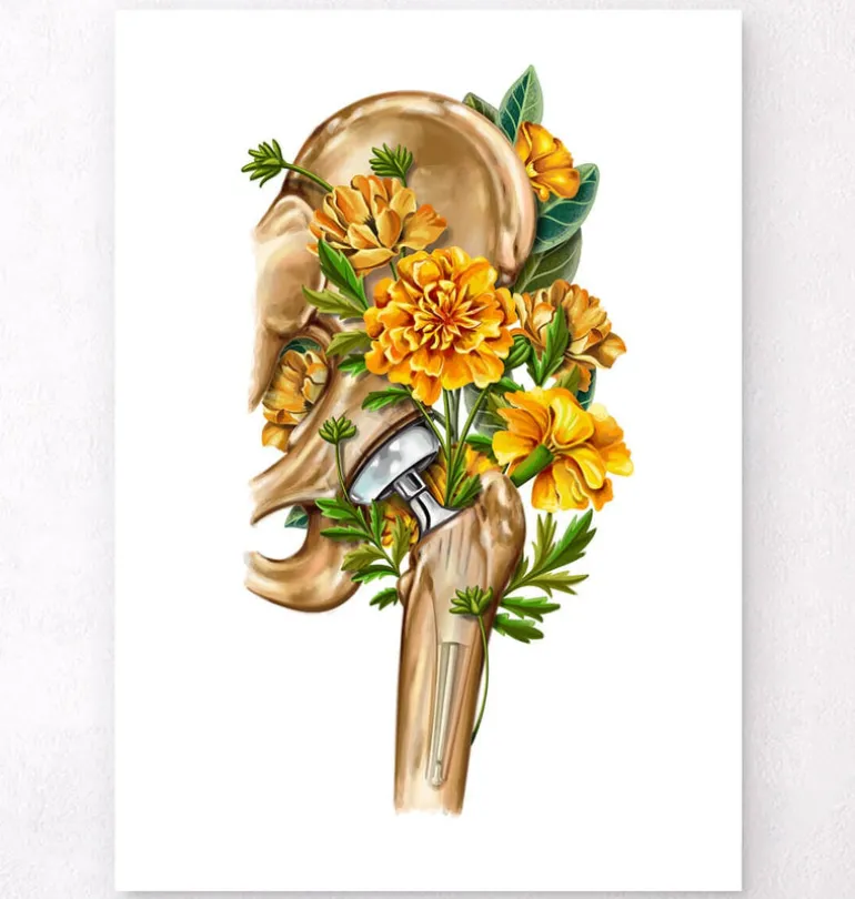 Prothèse totale de hanche - Floral - Blanc