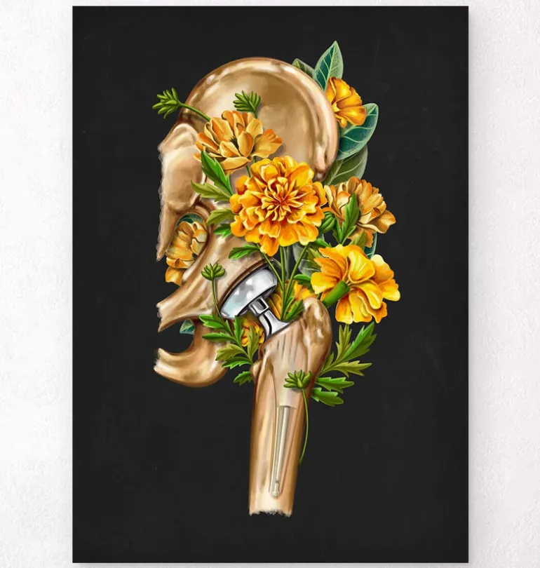 Prothèse totale de hanche - Floral - Noir