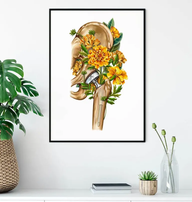 Prothèse totale de hanche - Floral - Blanc